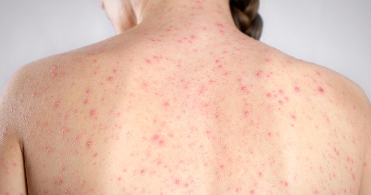 ผู้ป่วยไข้หวัดใหญ่